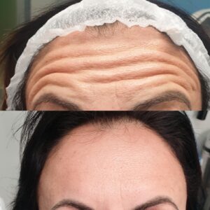 riduzione rughe del volto :terapia laser o iniettabili