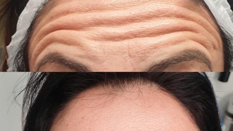 riduzione rughe del volto :terapia laser o iniettabili